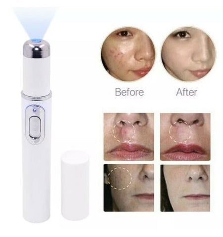 Medical Blue Light Therapy Laser Treatment Pen Acne Scar Wrinkle Removal