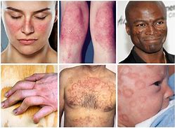 Lupus consultation Scan