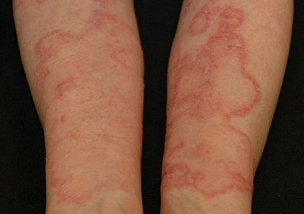 Lupus consultation Scan